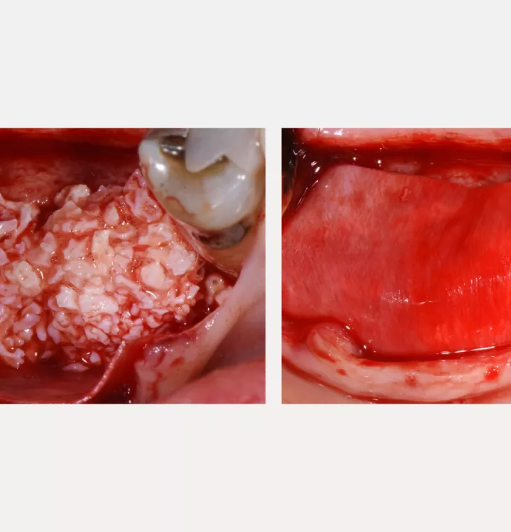 Nobel Biocare Clinical Case