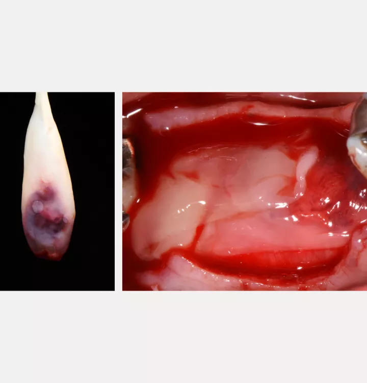 Nobel Biocare Clinical Case