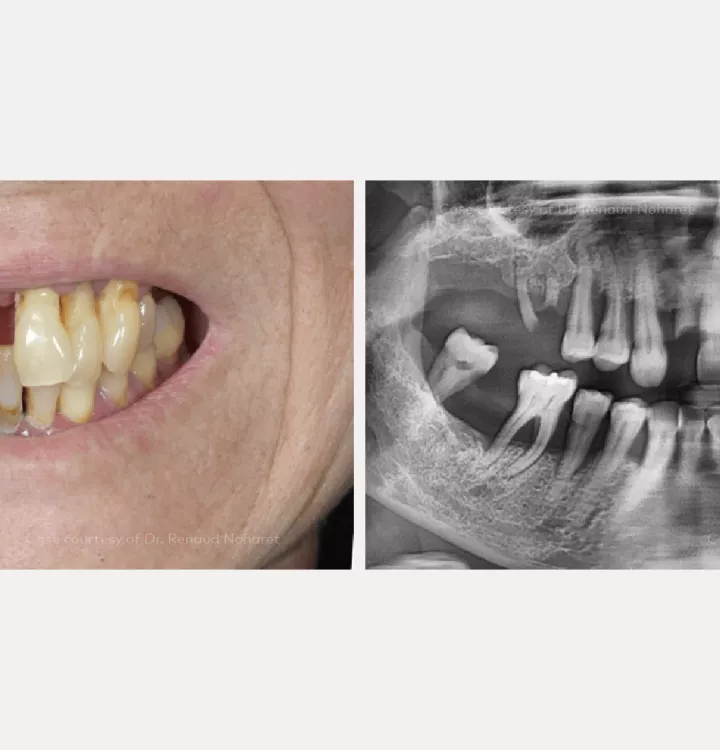 Case courtesy of Dr. Noharet