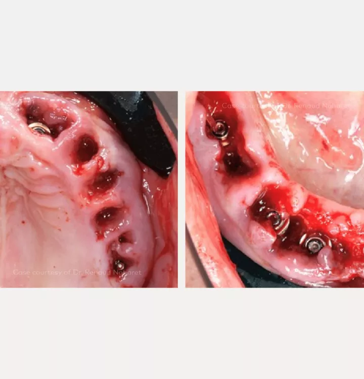 Case courtesy of Dr. Noharet