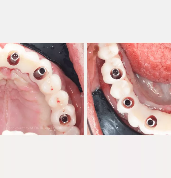 Case courtesy of Dr. Noharet