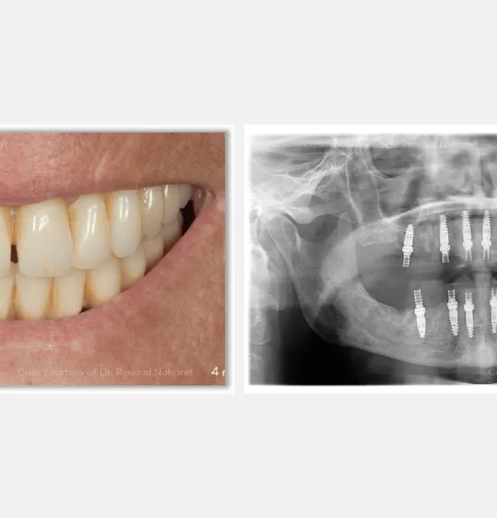 Case courtesy of Dr. Noharet