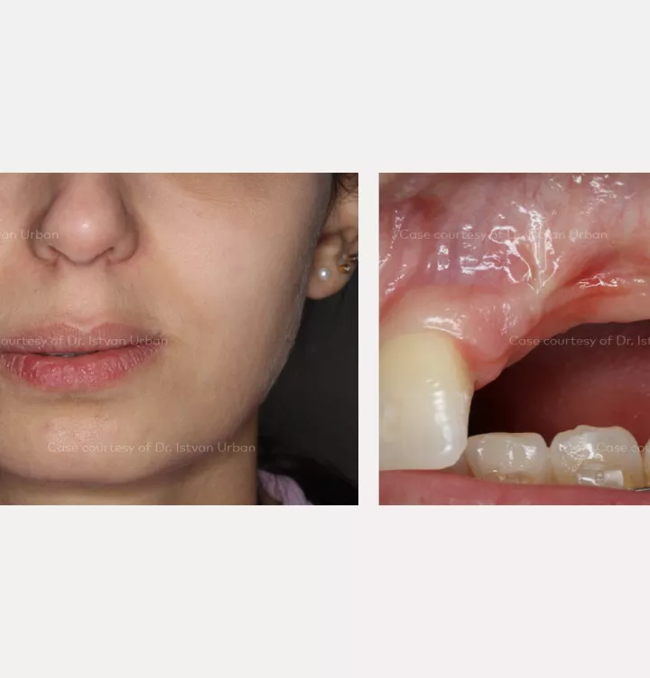 Vertical ridge augmentation of the anterior maxilla using creos™ syntoprotect mesh
