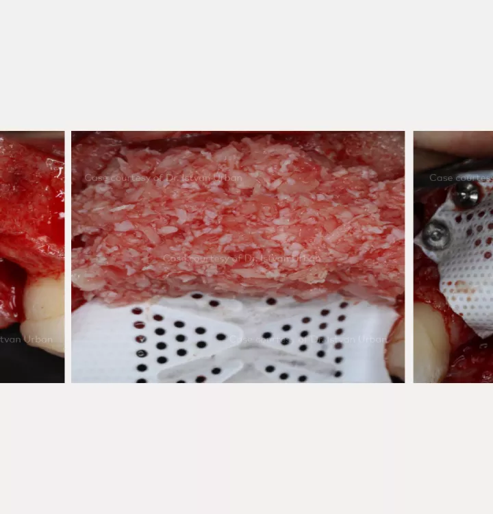 Vertical ridge augmentation of the anterior maxilla using creos™ syntoprotect mesh