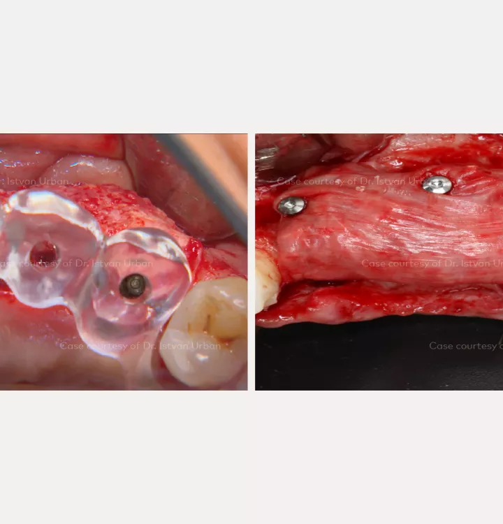 Vertical ridge augmentation of the anterior maxilla using creos™ syntoprotect mesh