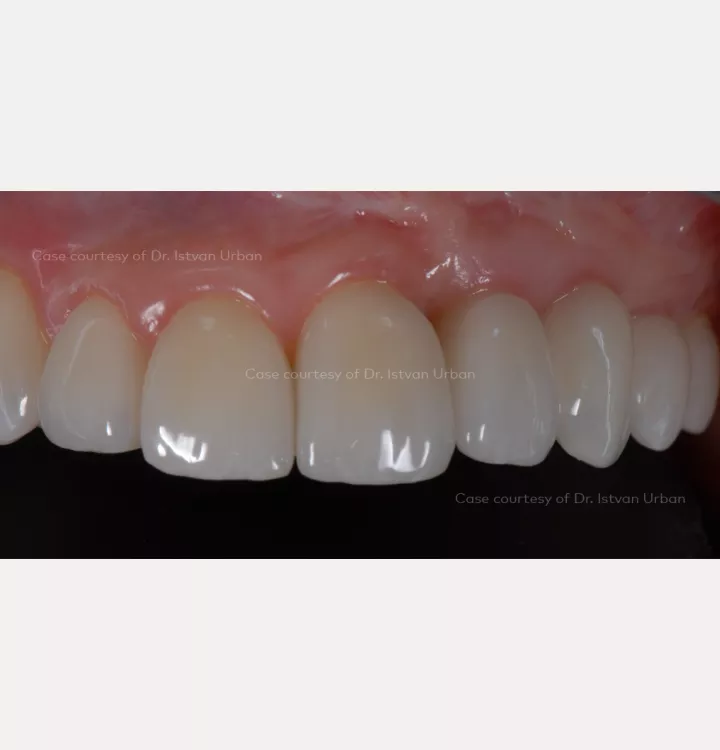 Vertical ridge augmentation of the anterior maxilla using creos™ syntoprotect mesh
