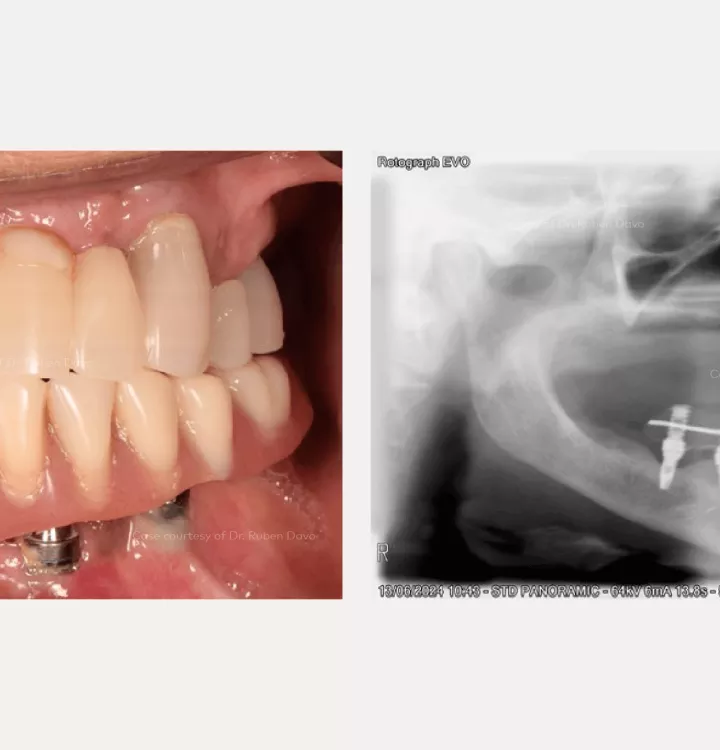 Case courtesy of Dr. Davó