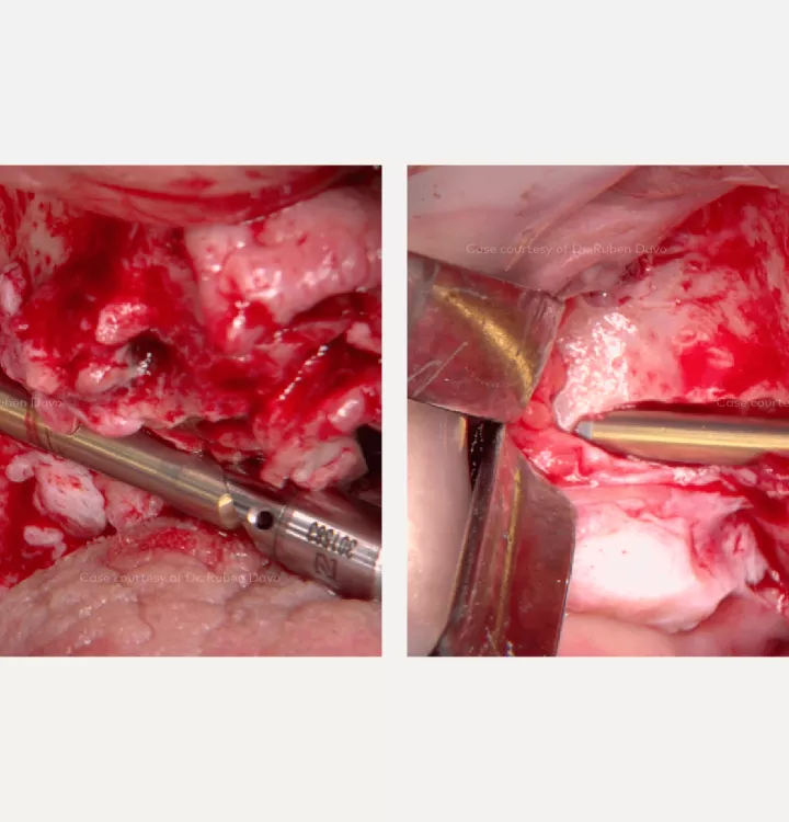 Case courtesy of Dr. Davó