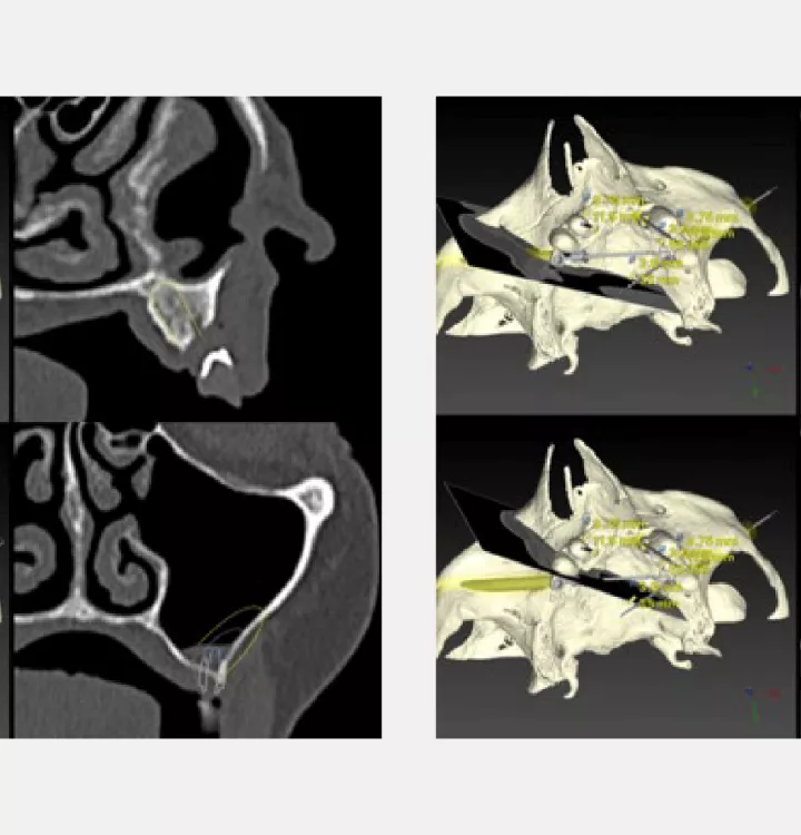 Case courtesy of Dr. Davó
