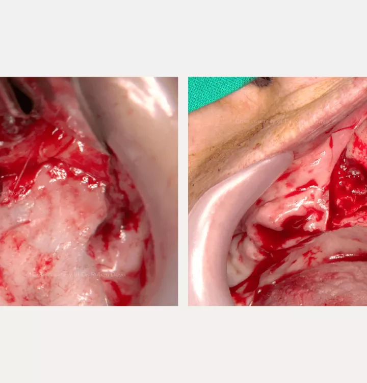 Case courtesy of Dr. Davó