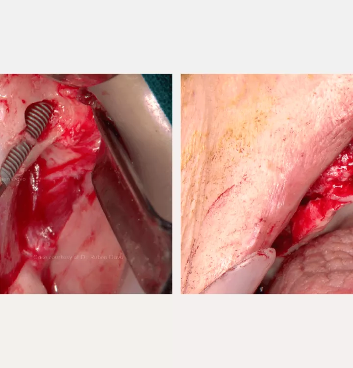 Case courtesy of Dr. Davó