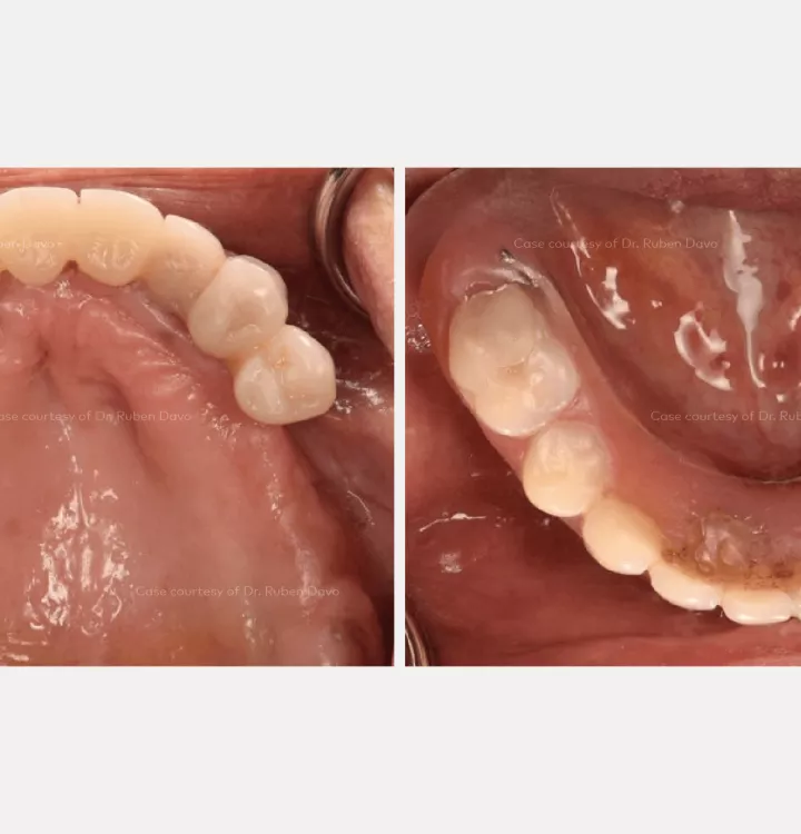 Case courtesy of Dr. Davó