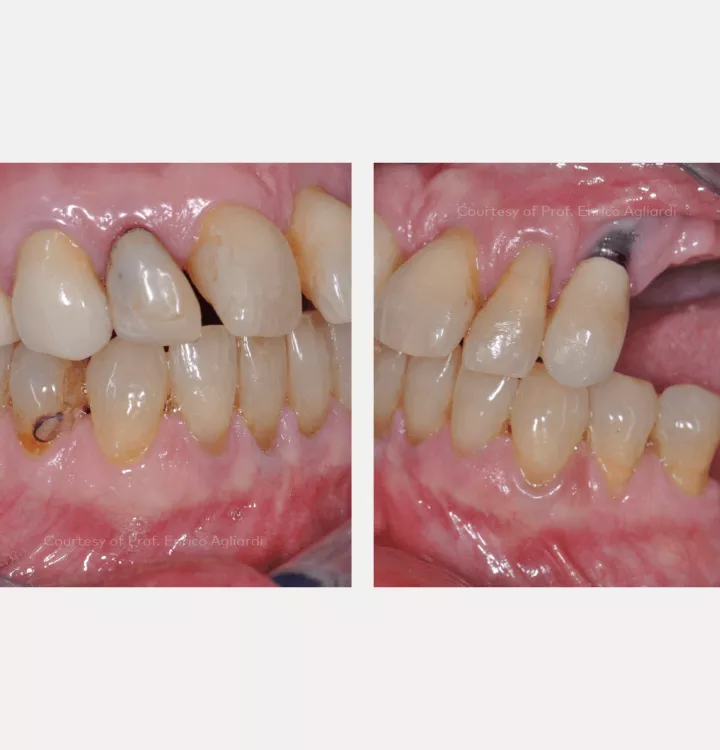 Case courtesy of Prof. Enrico Agliardi