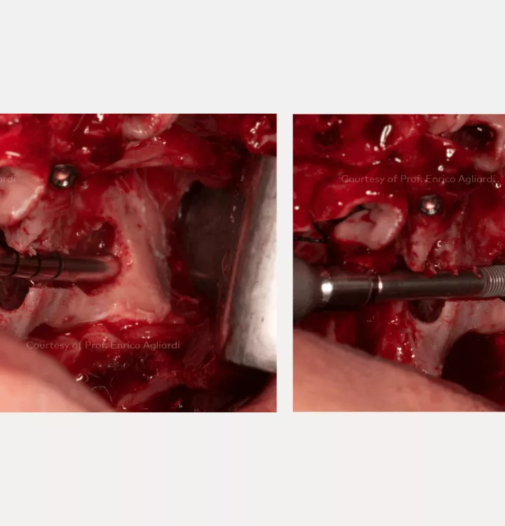 Case courtesy of Prof. Enrico Agliardi