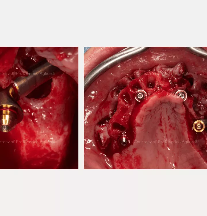 Case courtesy of Prof. Enrico Agliardi
