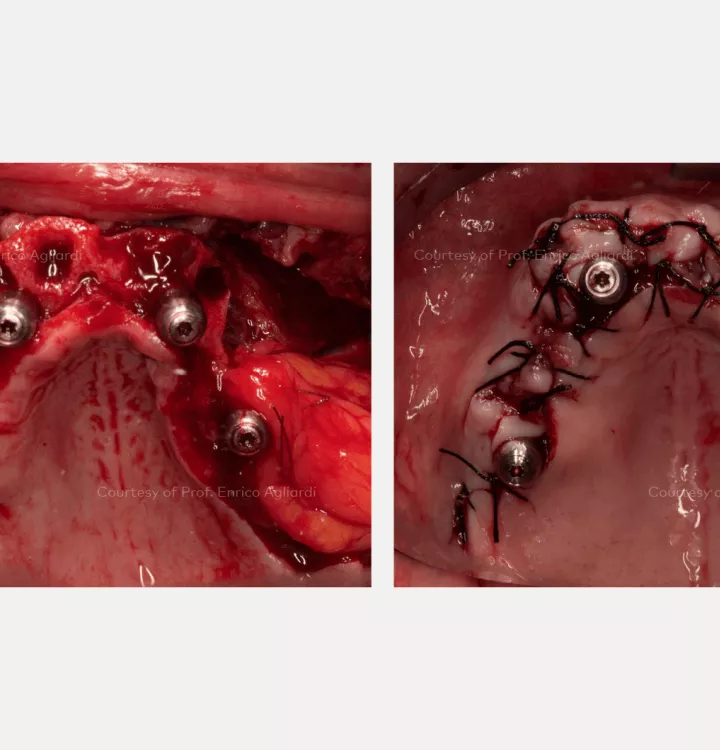 Case courtesy of Prof. Enrico Agliardi