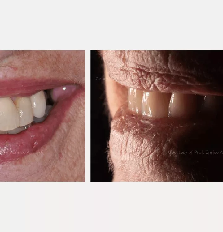 Case courtesy of Prof. Enrico Agliardi