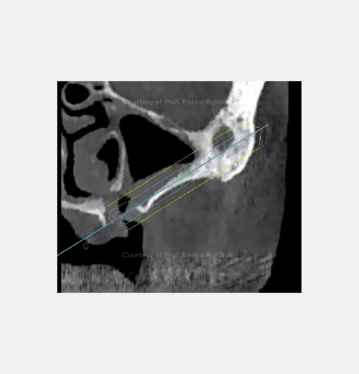 Case courtesy of Prof. Enrico Agliardi