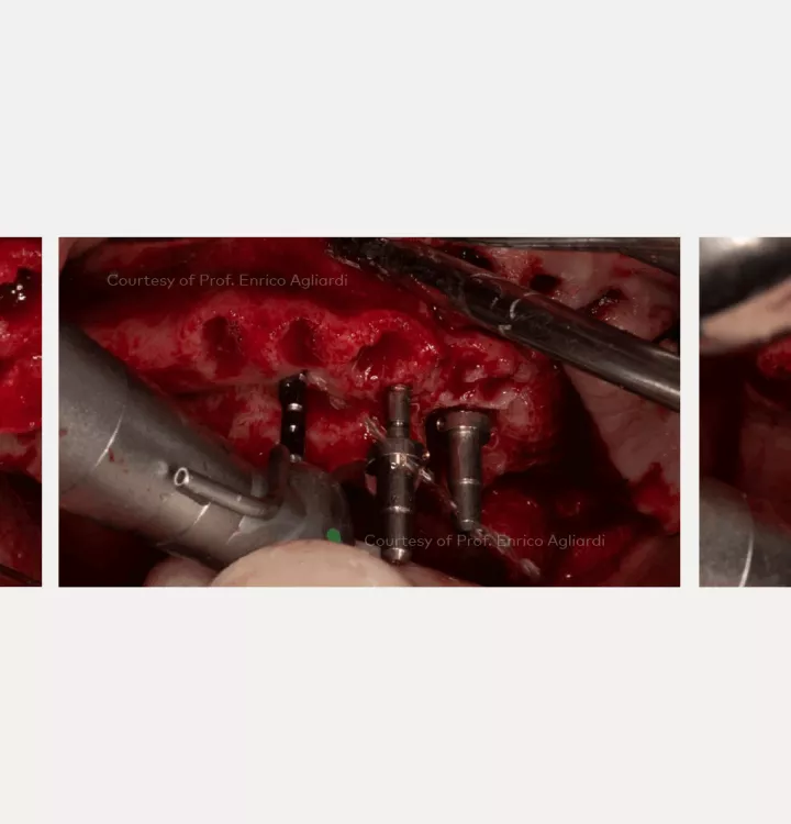 Case courtesy of Prof. Enrico Agliardi