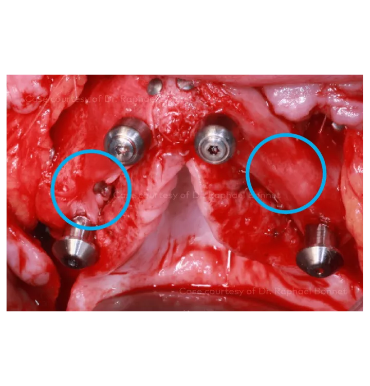 Case courtesy of Dr. Raphael Bonnet