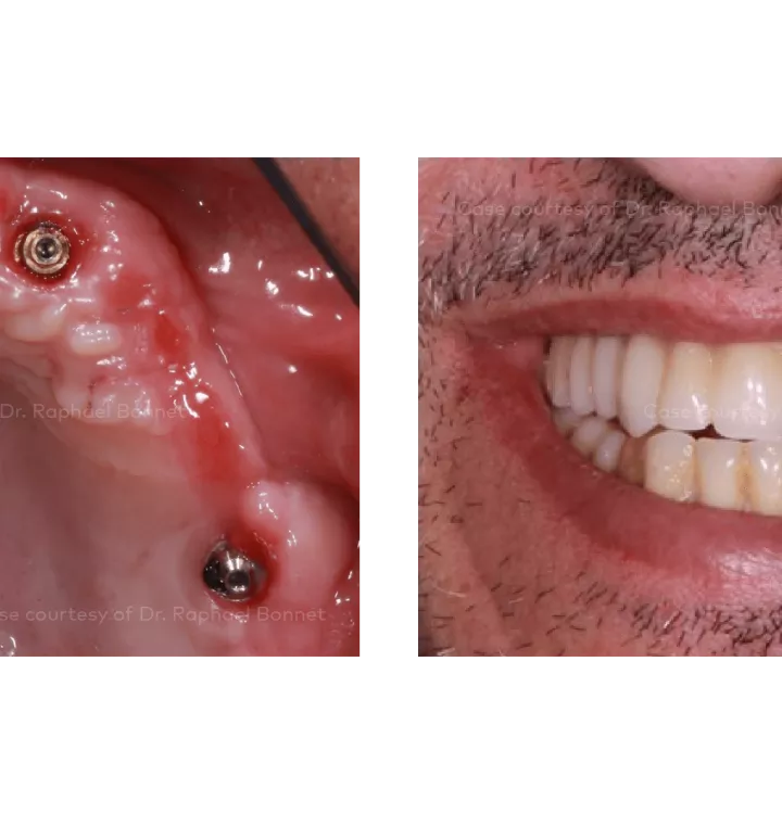Case courtesy of Dr. Raphael Bonnet