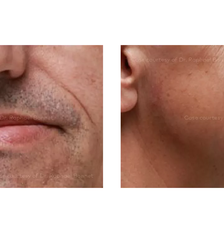 Case courtesy of Dr. Raphael Bonnet