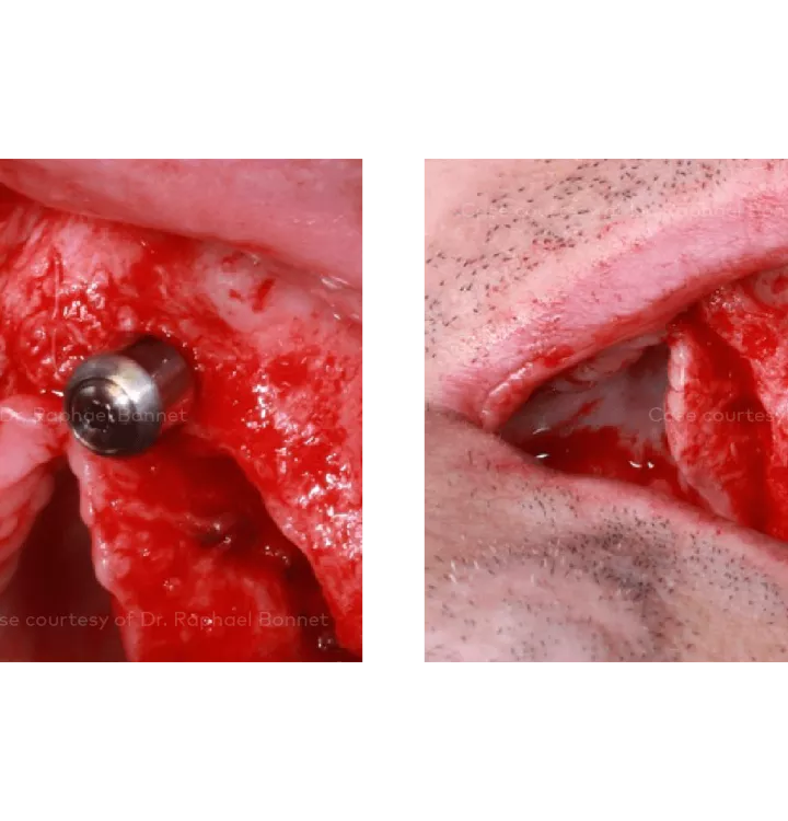 Case courtesy of Dr. Raphael Bonnet