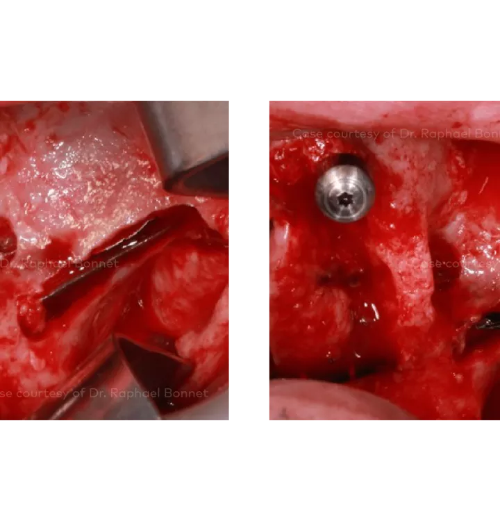 Case courtesy of Dr. Raphael Bonnet