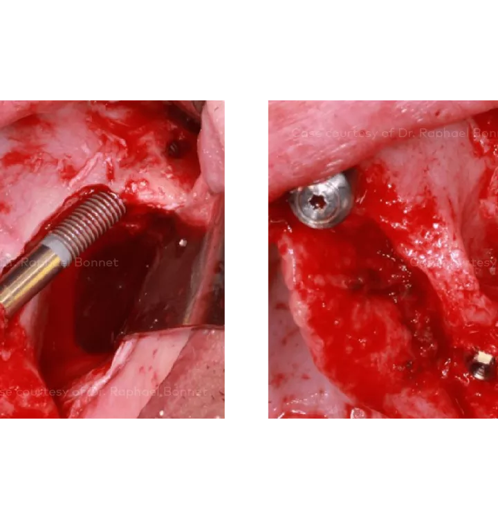 Case courtesy of Dr. Raphael Bonnet