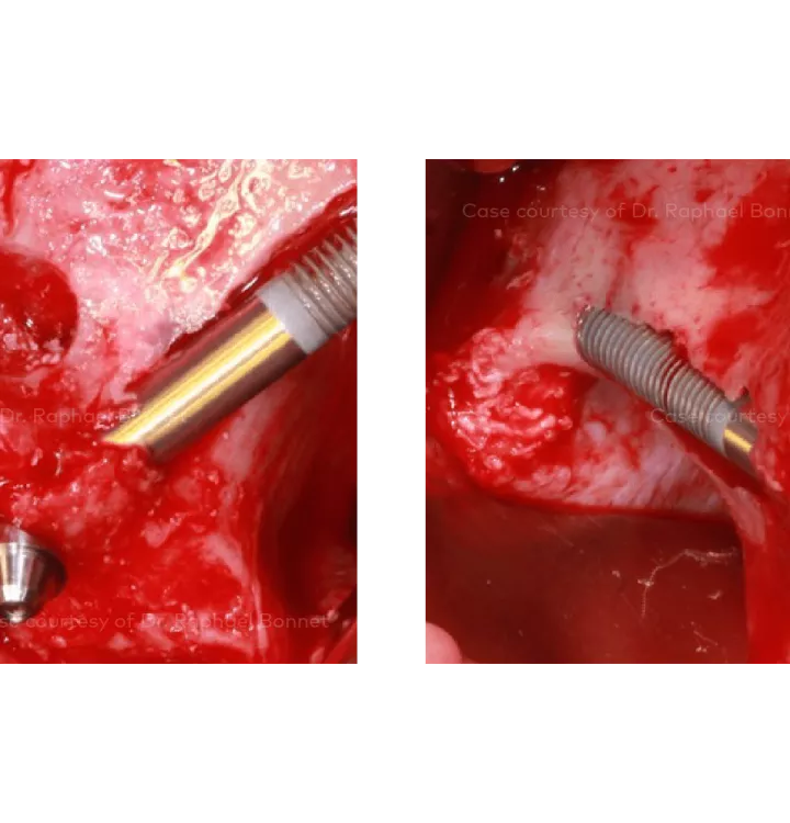 Case courtesy of Dr. Raphael Bonnet