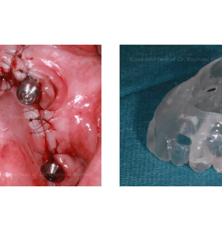 Case courtesy of Dr. Raphael Bonnet