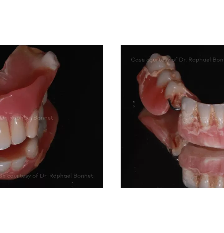 Case courtesy of Dr. Raphael Bonnet