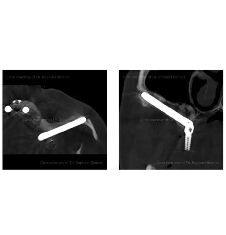 Case courtesy of Dr. Raphael Bonnet