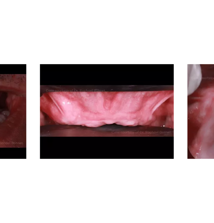 Case courtesy of Dr. Raphael Bonnet