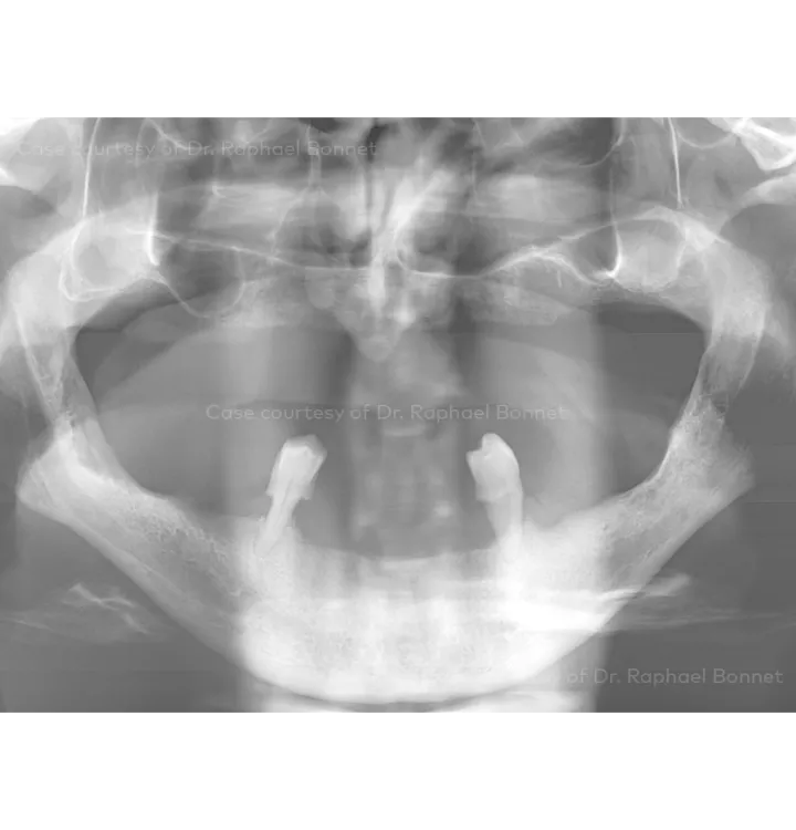 Case courtesy of Dr. Raphael Bonnet