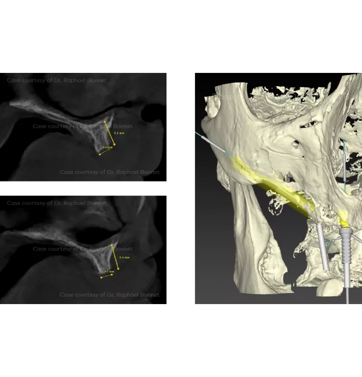 Case courtesy of Dr. Raphael Bonnet