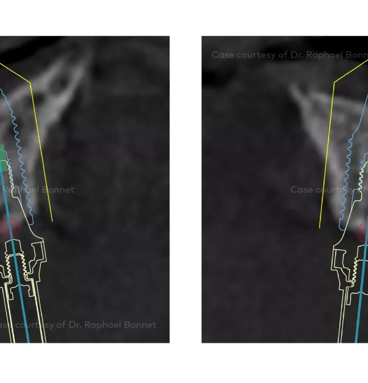 Case courtesy of Dr. Raphael Bonnet