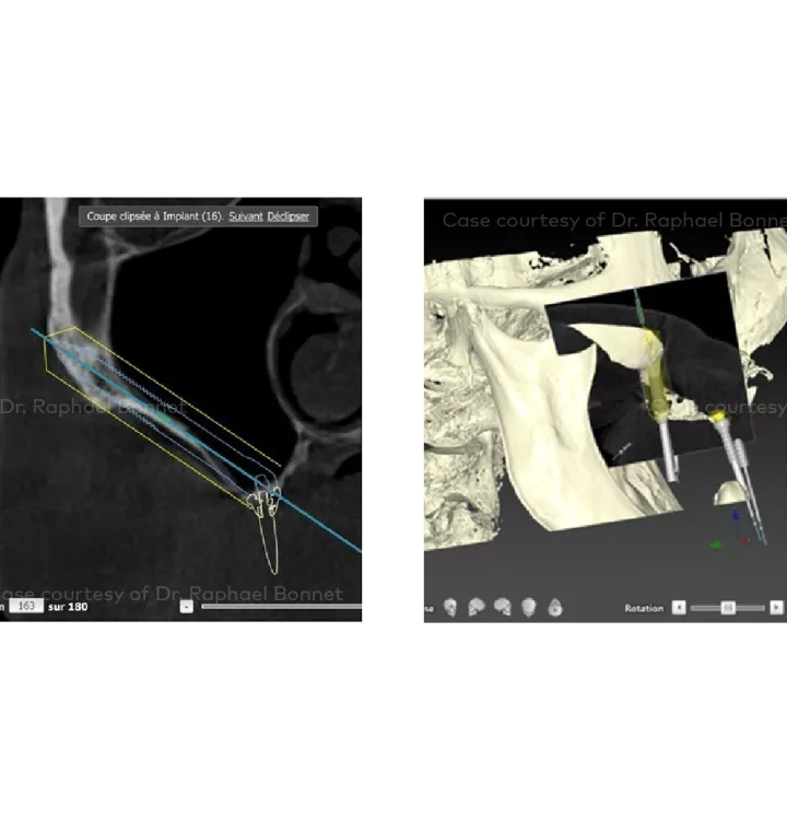 Case courtesy of Dr. Raphael Bonnet
