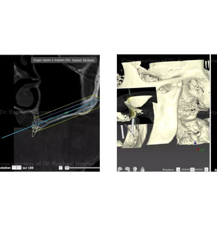 Case courtesy of Dr. Raphael Bonnet