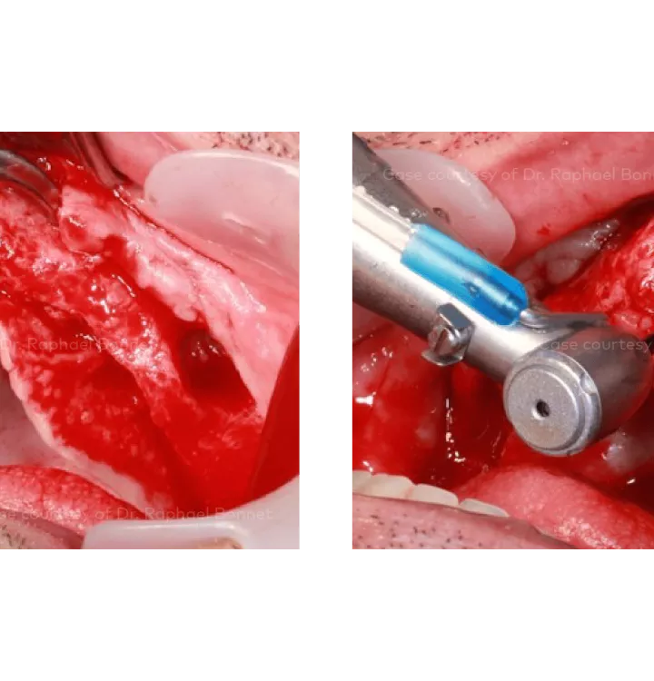 Case courtesy of Dr. Raphael Bonnet