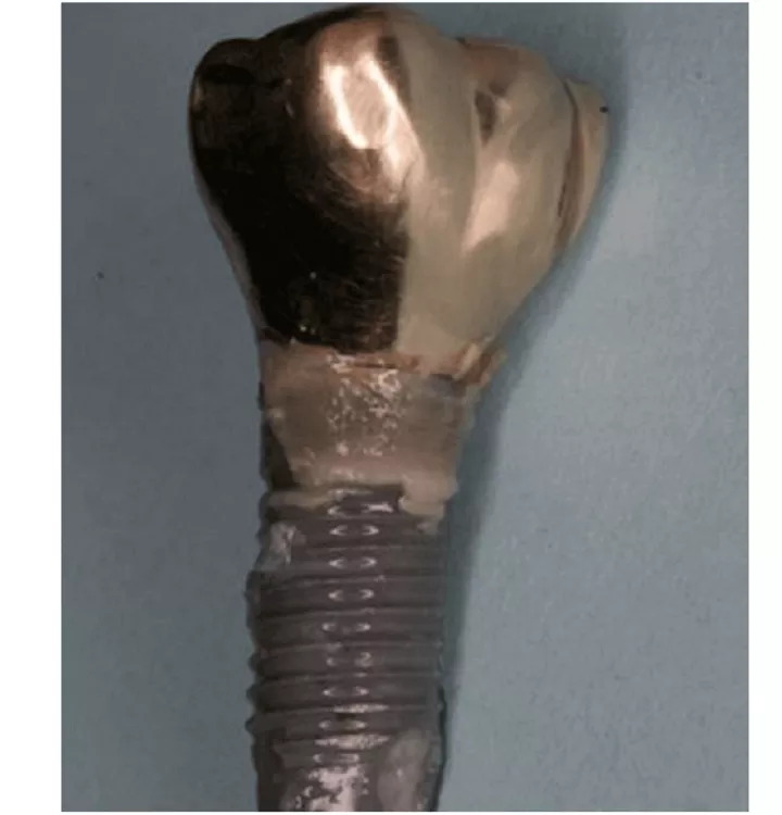 Failed implant with cement remnants