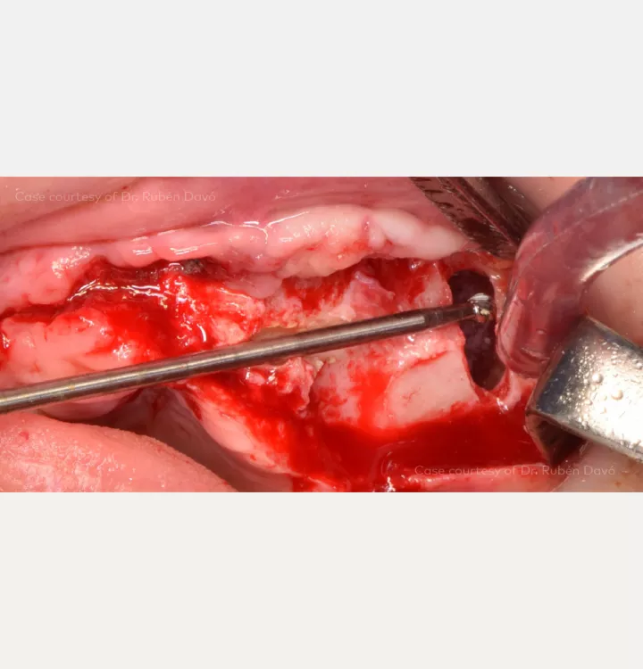 Preparation of slot and osteotomy on zygoma bone