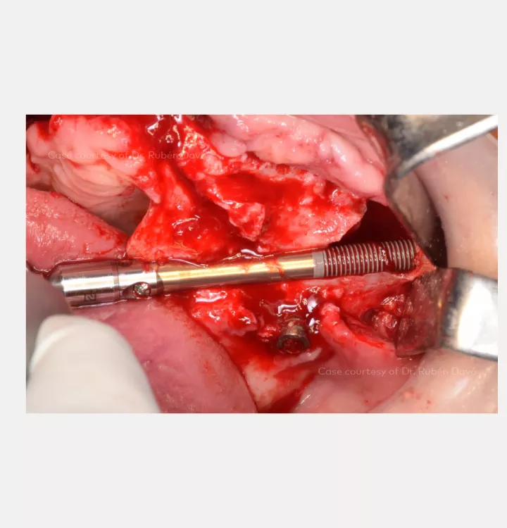 Zygoma implant insertion through the maxillary slot