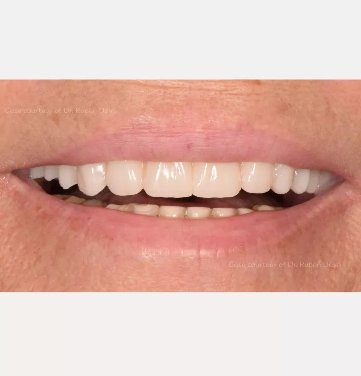 Provisional prosthesis in place – frontal view