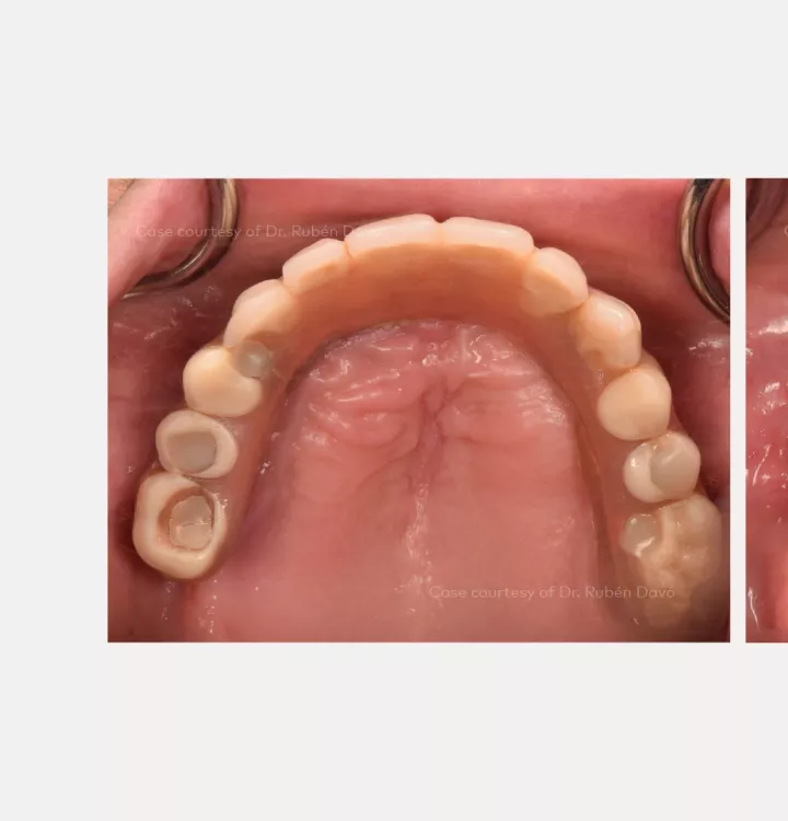 Intraooral pre-op maxillary arch
