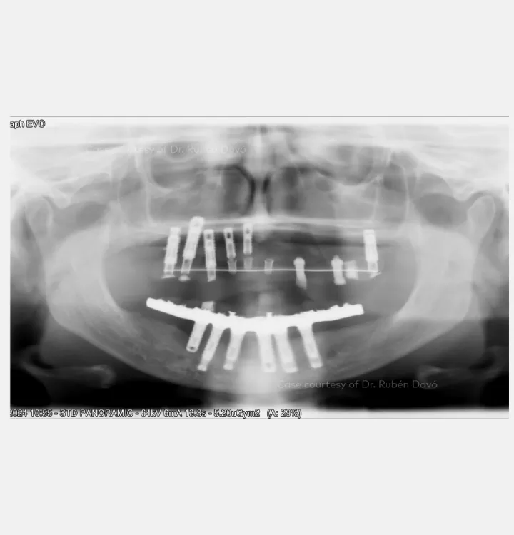 OPG showing existing implants in the maxillary and mandibular arch