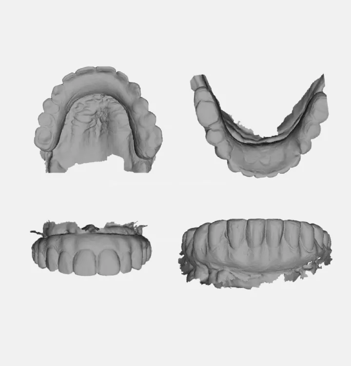STL scan with the old denture