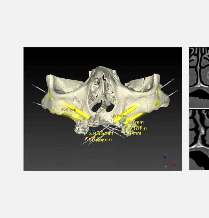 4 Zygoma implants using sinus slot technique