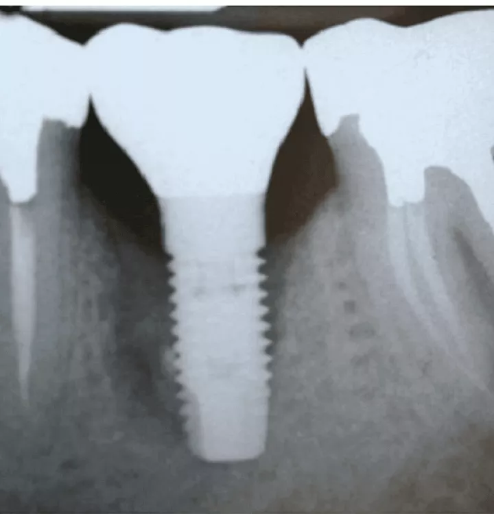 X-ray of failed implant with cement remnants.