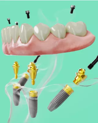 Nobel Biocare All-on-4 treatment concept